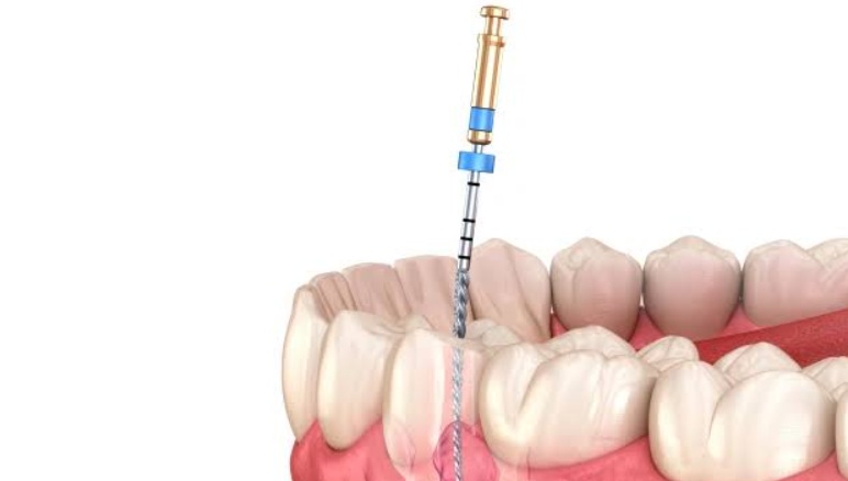 root canal image